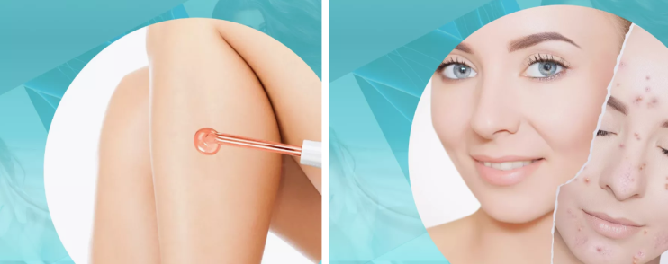 MS-279 Дарсонваль для лица и тела