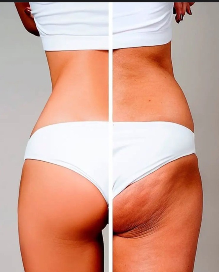 MS-030 Антицеллюлитный вакуумный массажер Cellules MD